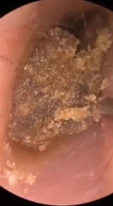 @Ear Cleaning