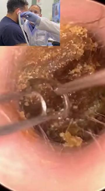 @Ear Cleaning
