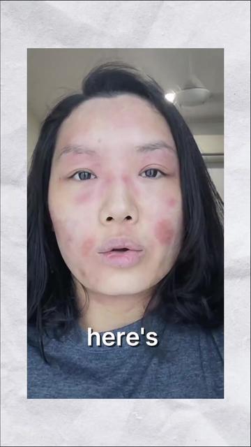 @Grace | TSW & Eczema Recovery