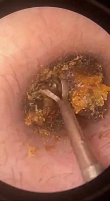 @Ear Cleaning