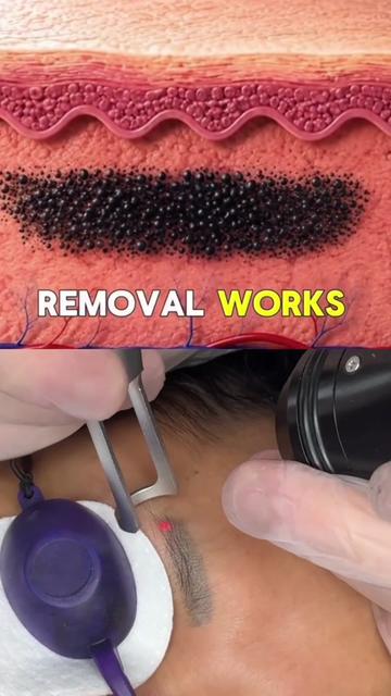 @Safe Eyebrows Tattoo Removal🗽