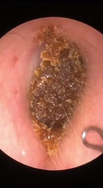 @Ear Cleaning
