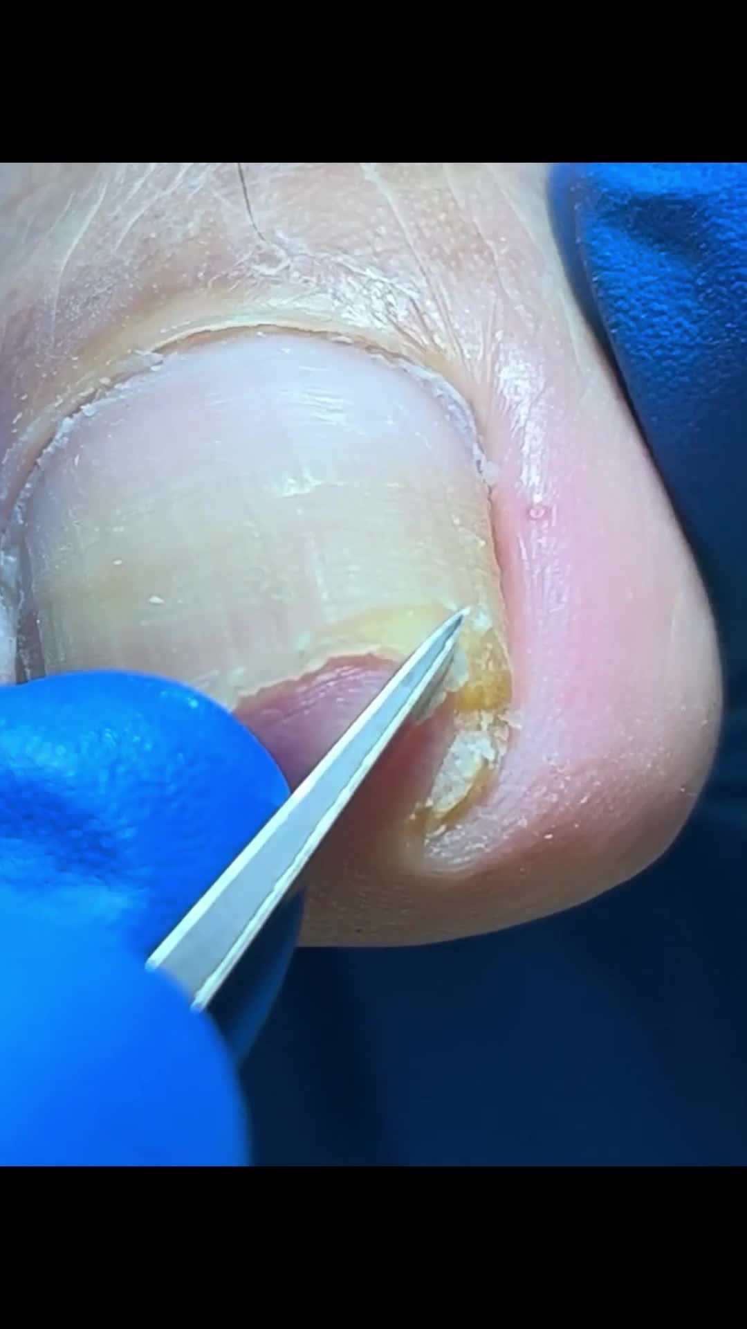 @Toenails.clips