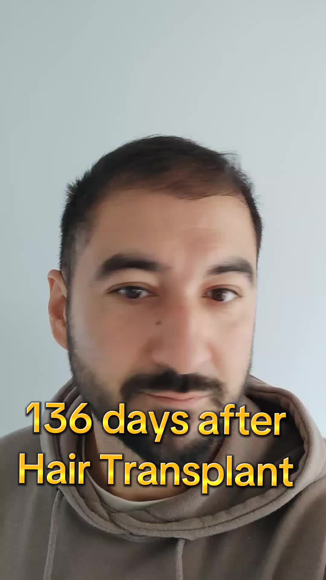 @My hair transplant