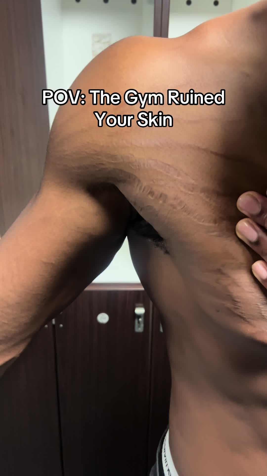 @Stretch marks guy