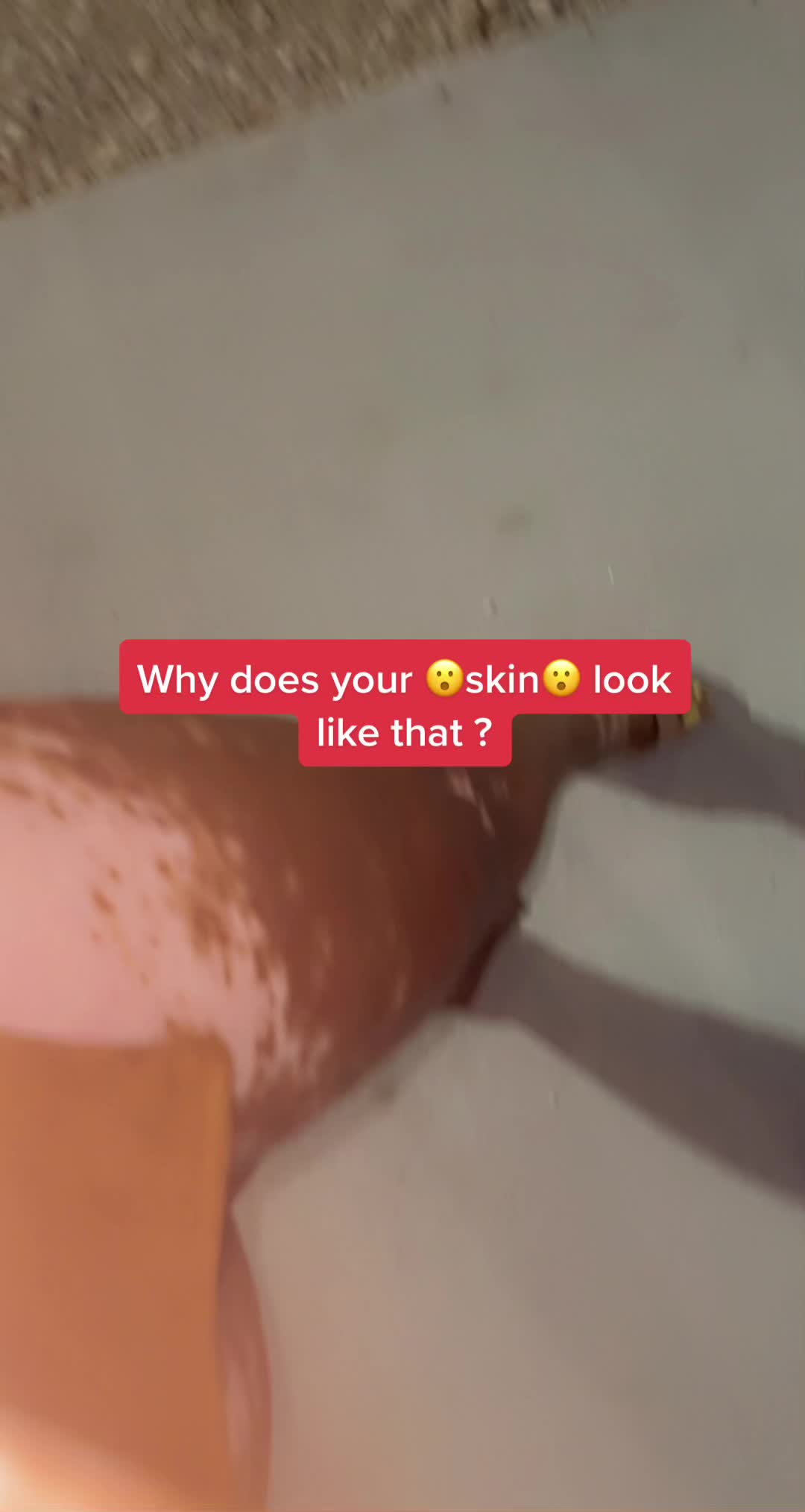 @VitiligoFairy