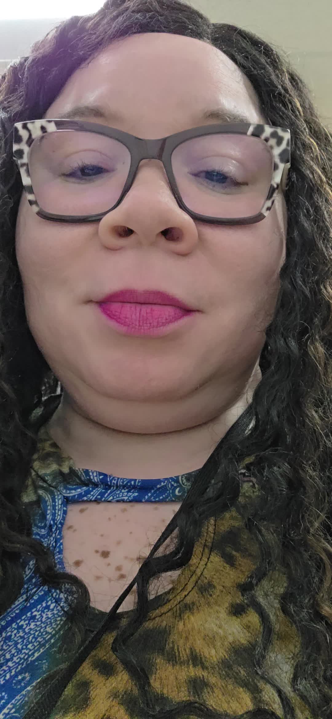 @Miss. PinkY(vitiligo girl)