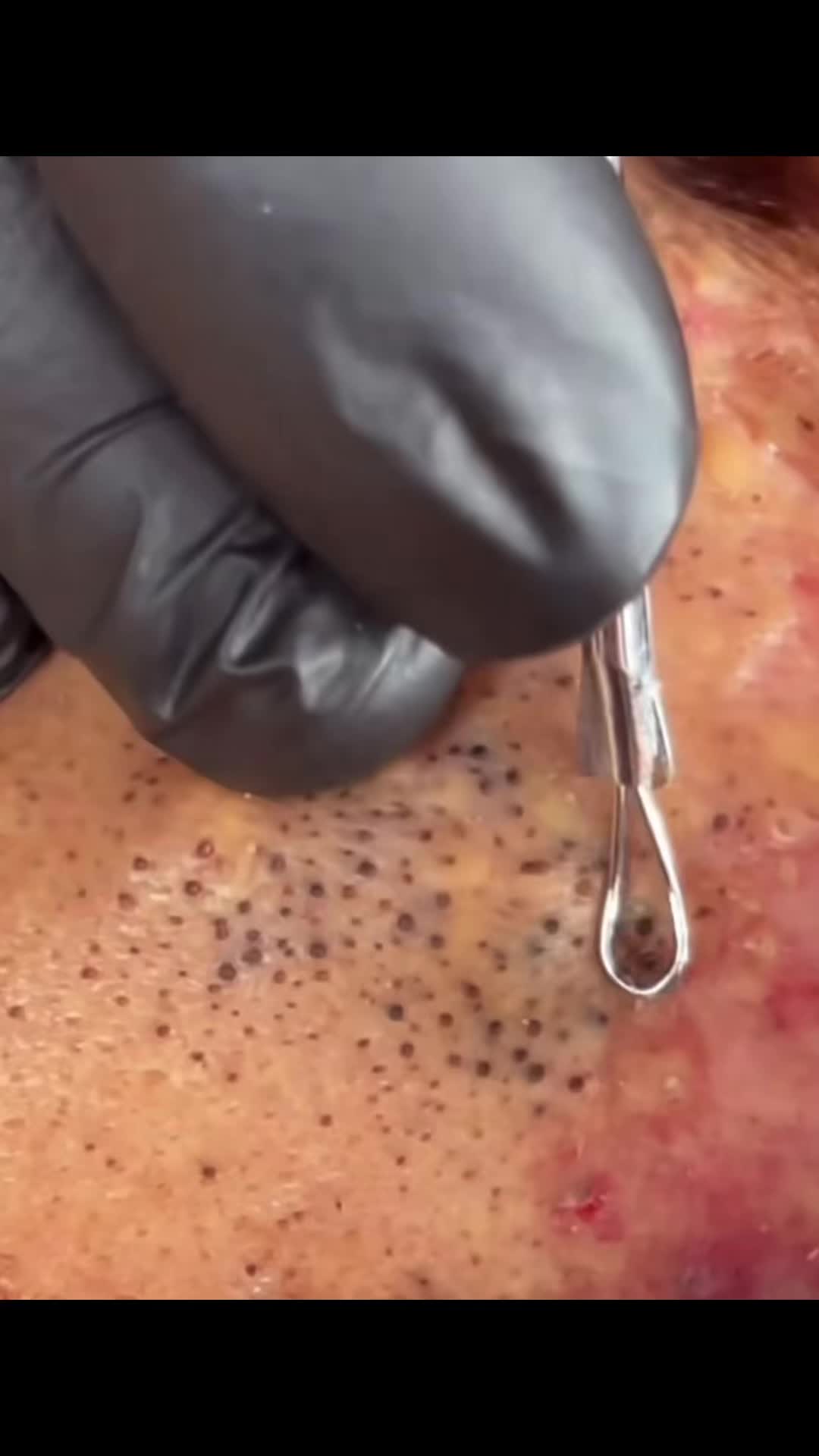 @pimplepopperasmr