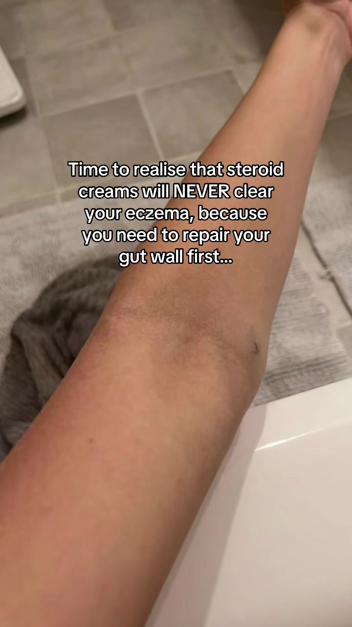 @Eczema Diaries USA & UK