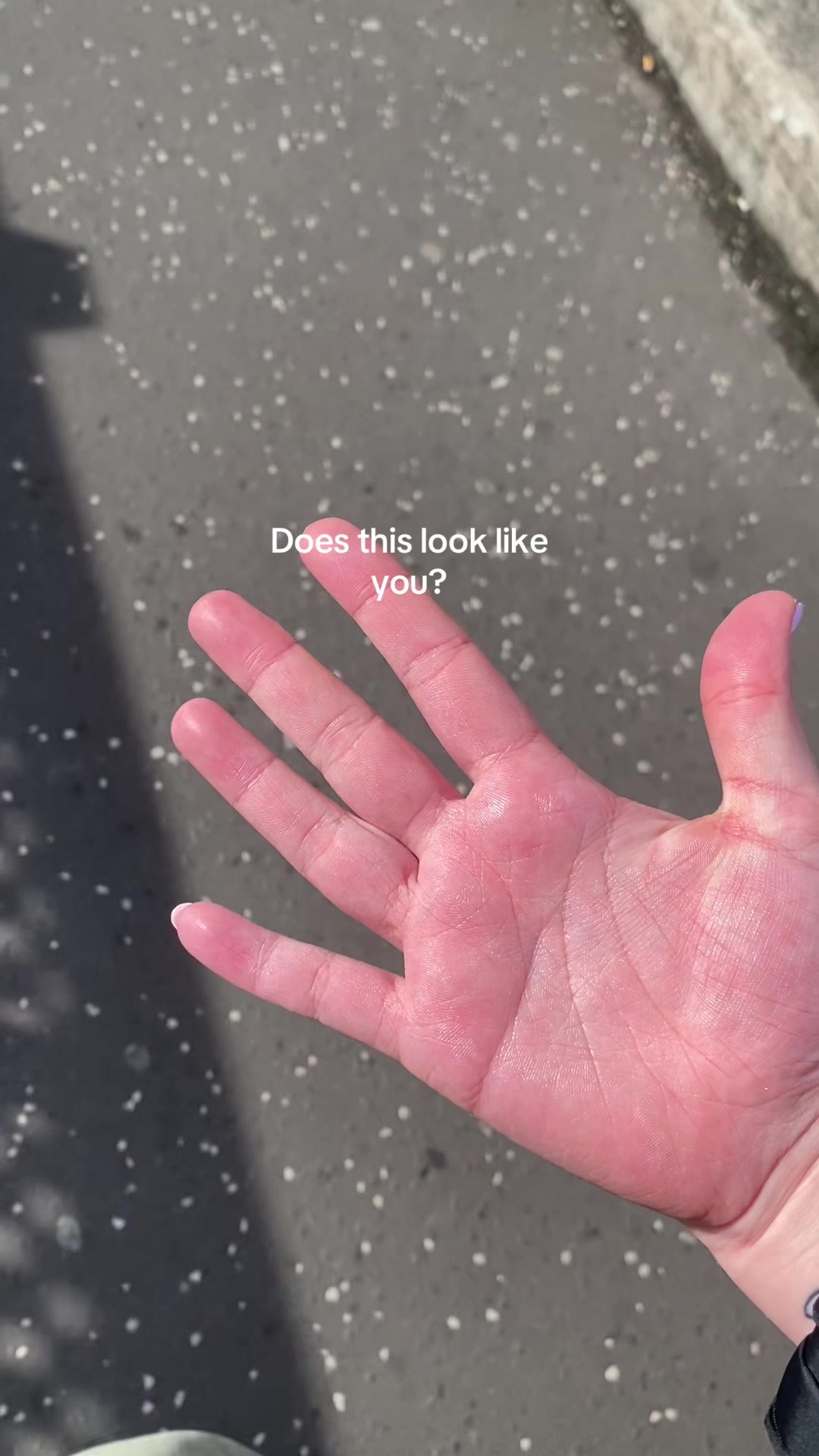 @LivingWithHyperhidrosis