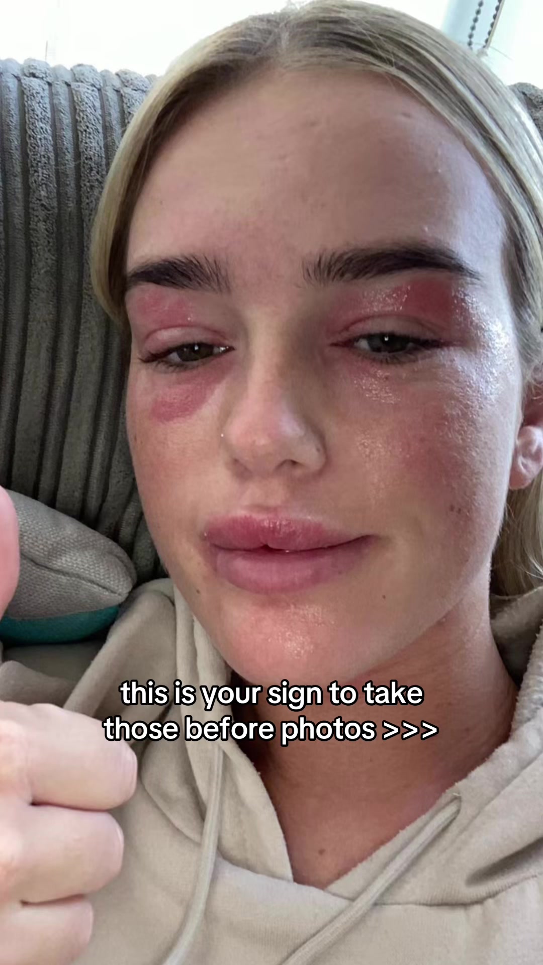 @Eczema Diaries USA & UK