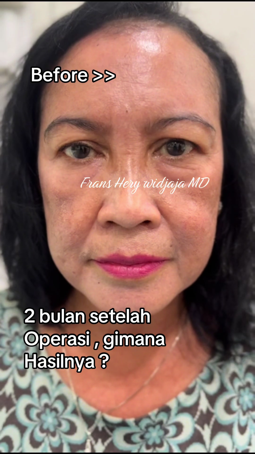 @FransHerywidjaja MD