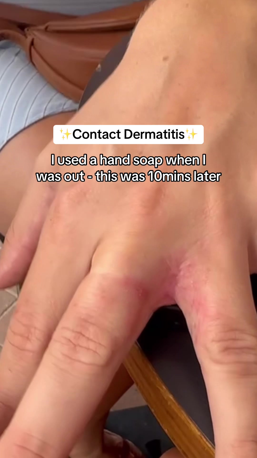 @Eczema Diaries USA & UK
