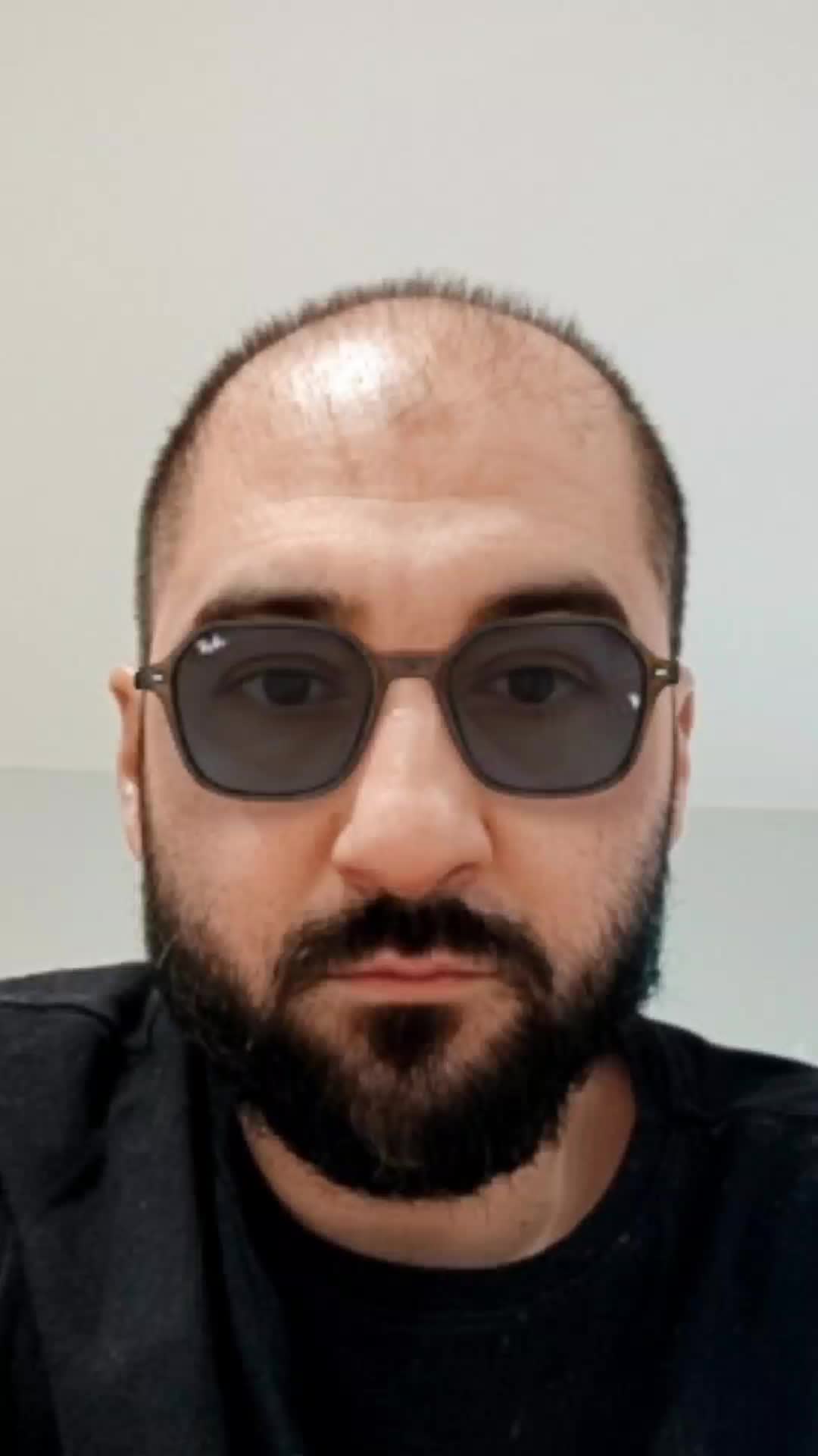 @My hair transplant