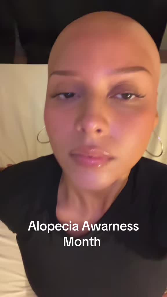 @AlopecianPrincess