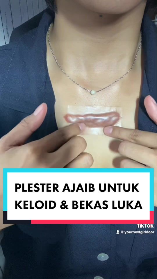 @DEVIYANITA | KELOID - HARDLENS