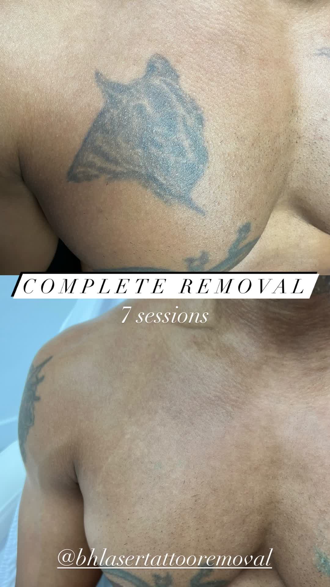 @@BHLASERTATTOOREMOVAL