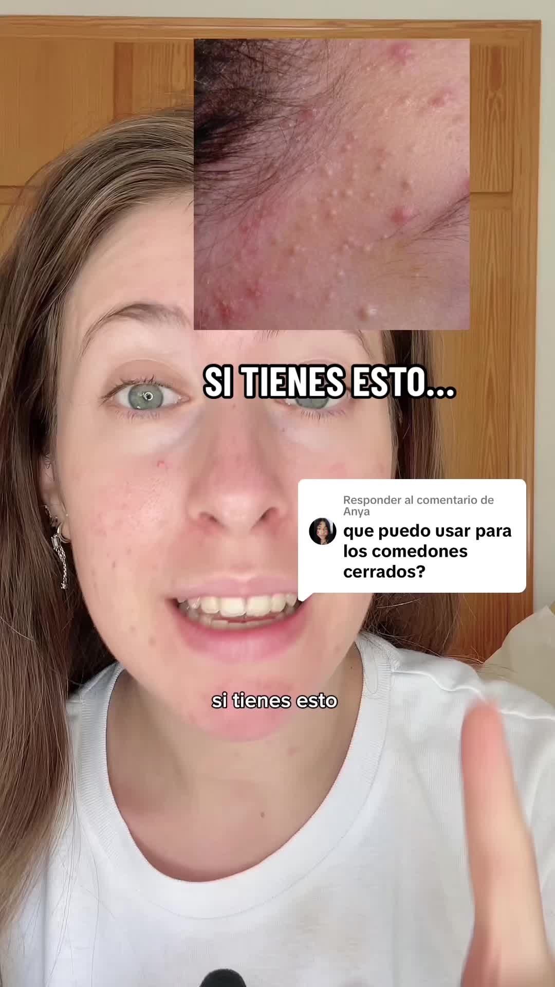@Claire 🎀 K-Beauty y acné
