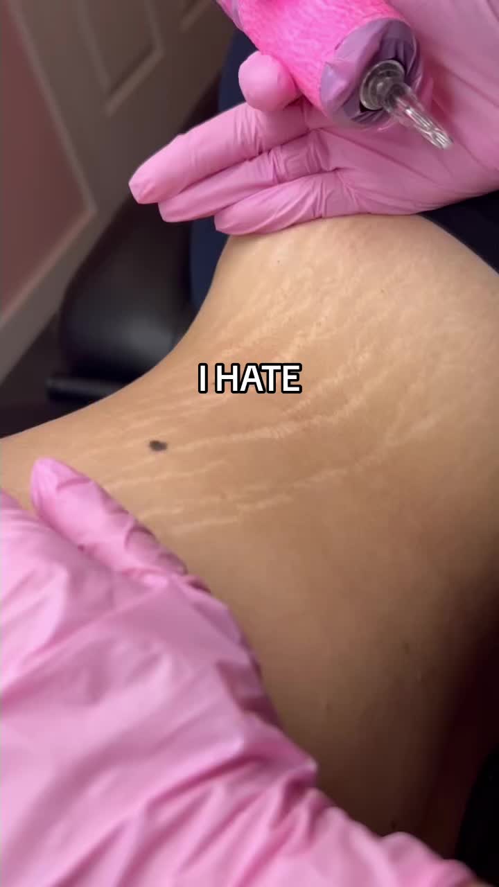 @Stretch Mark Fairy 🧚✨