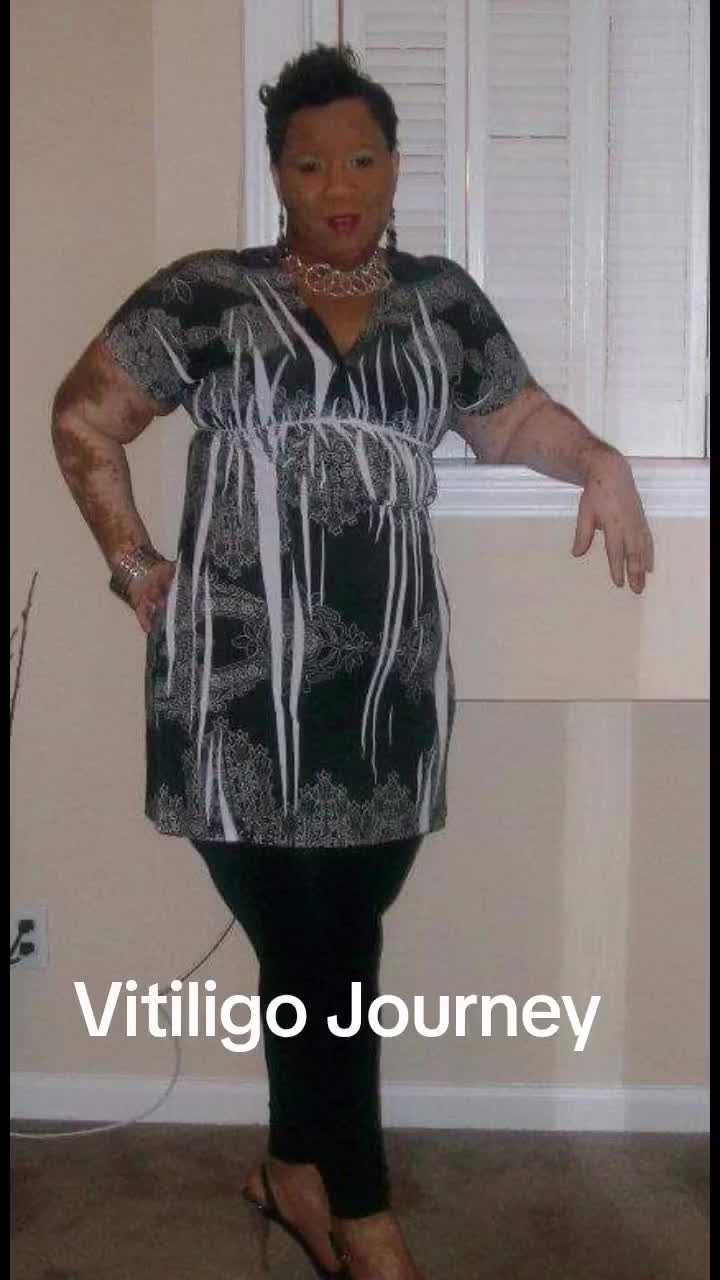 @Miss. PinkY(vitiligo girl)
