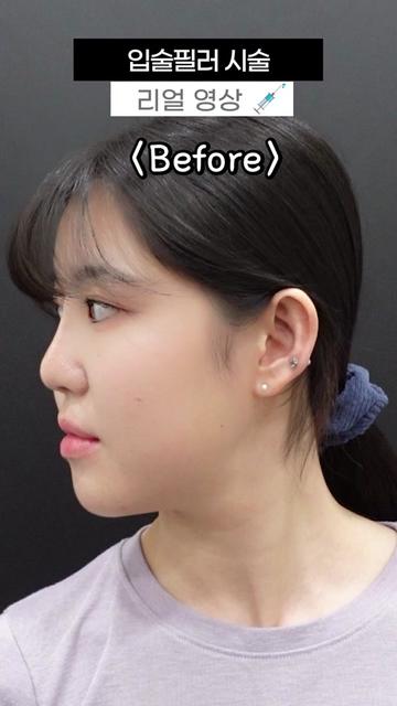 @금손닥터 이현주 Dr.GOLD_FILLER
