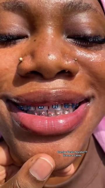 @Braces.bymavi|Smile Aesthetics