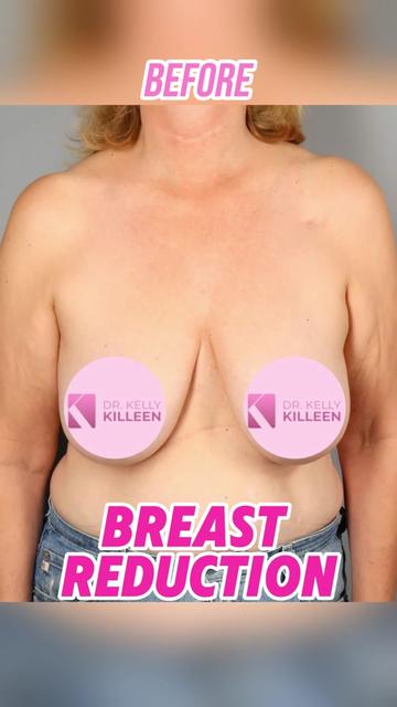 @Kelly Killeen, MD, FACS