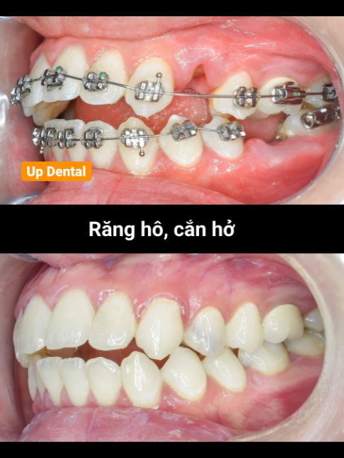 @Nha khoa niềng răng Up Dental