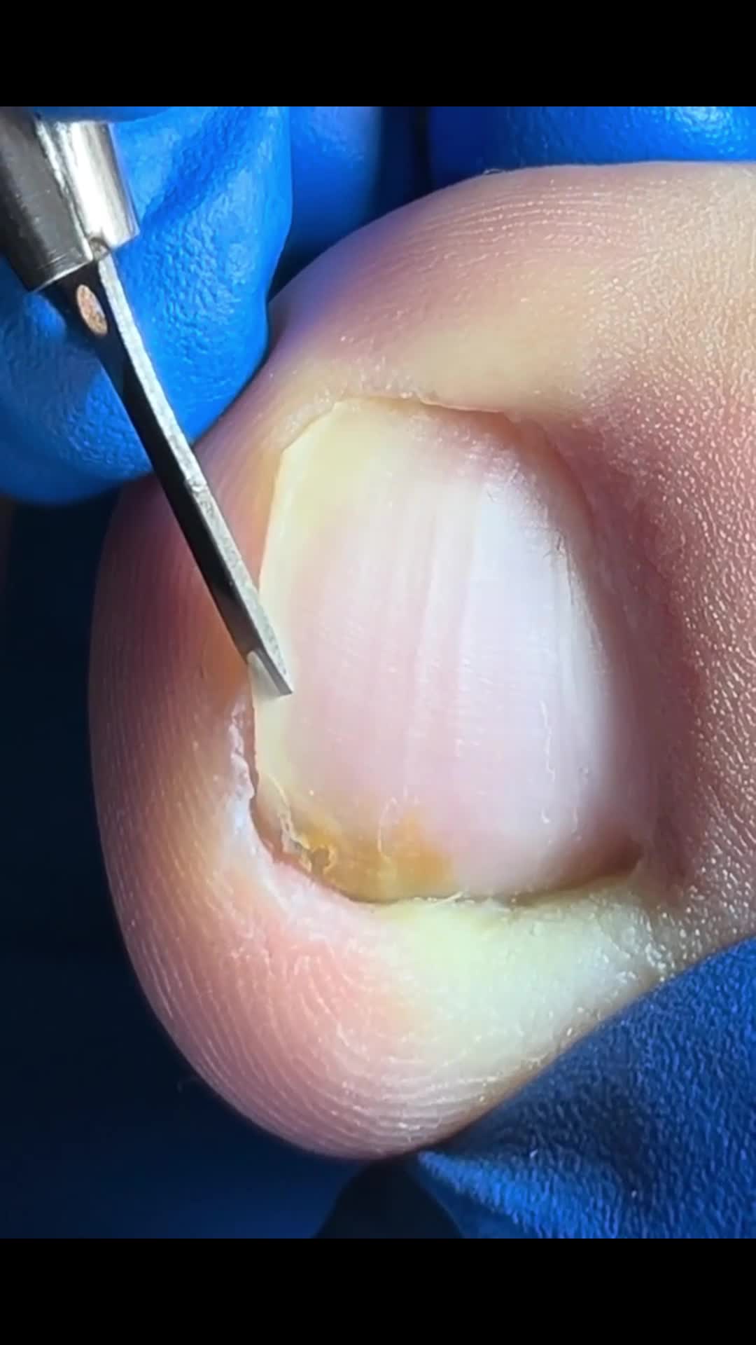@Toenails.clips