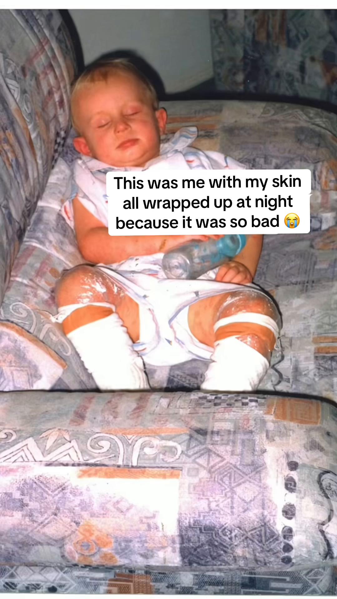 @Eczema Diaries USA & UK