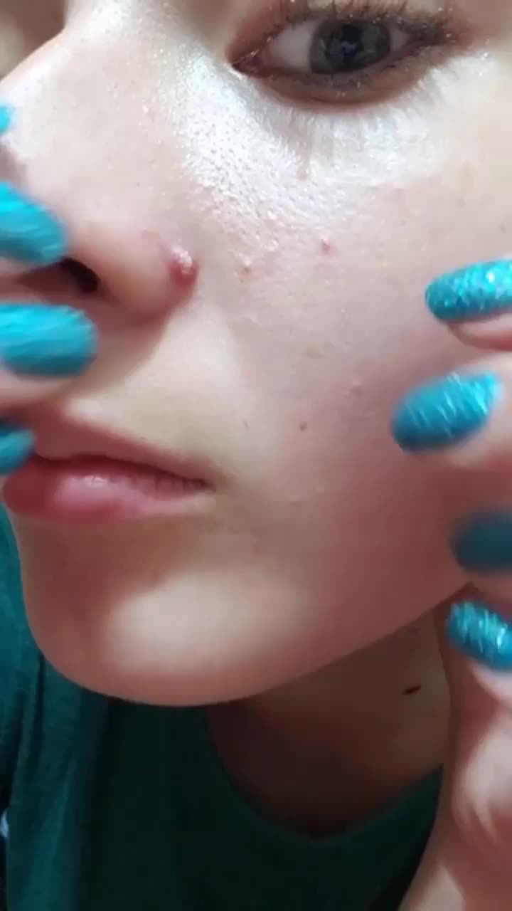 @Pimple Pooping