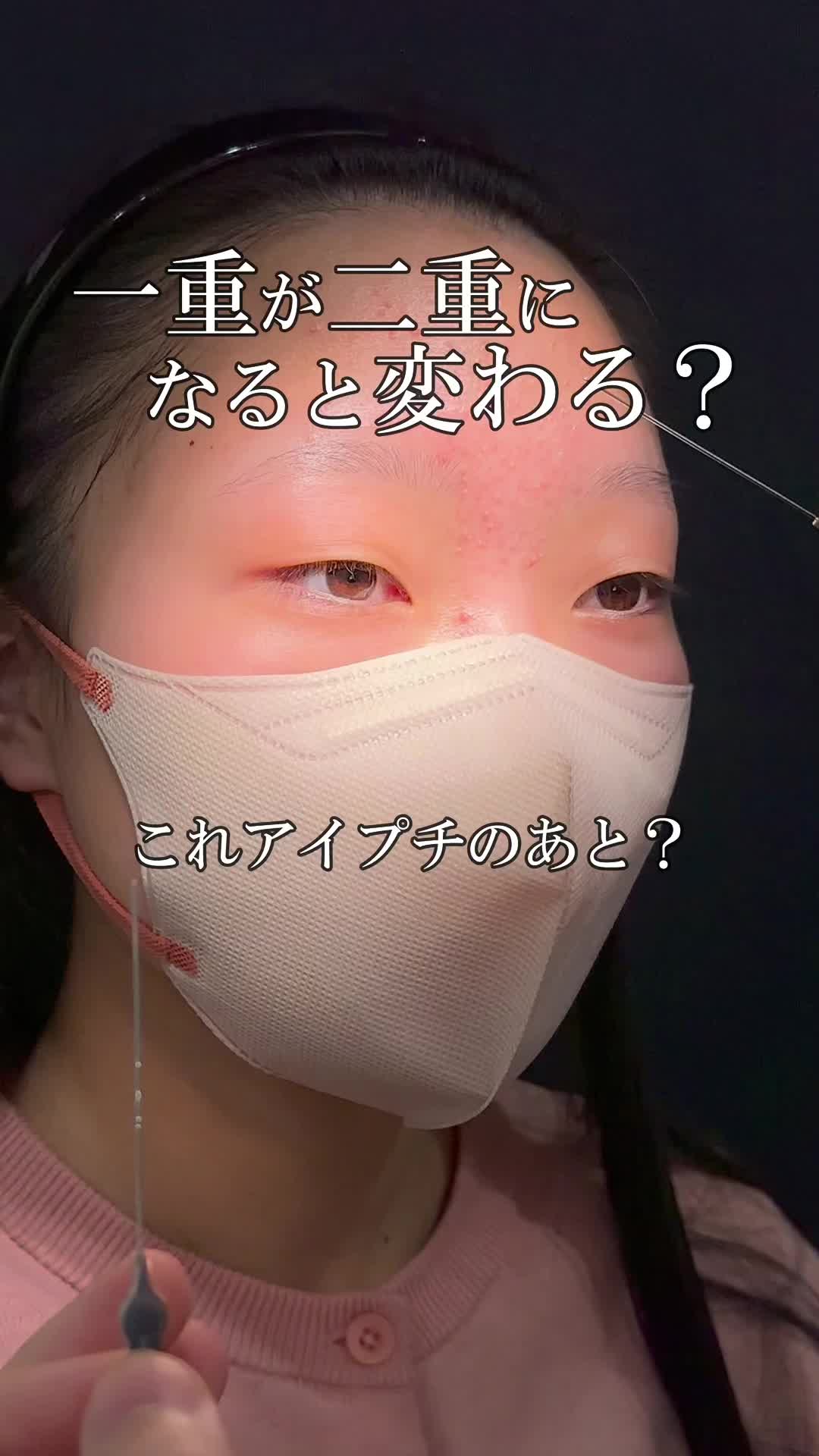@りく先生　目元切開/クマ治療