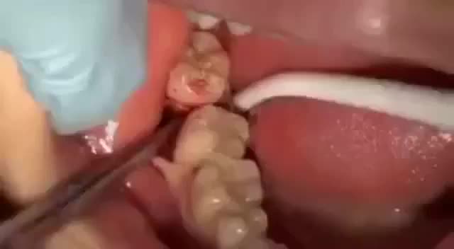 @Dent_tooth