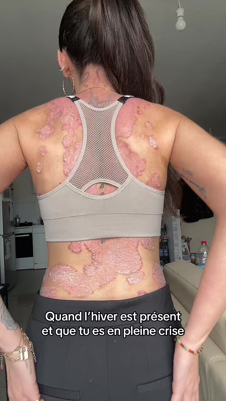 @lyla_psoriasistyle