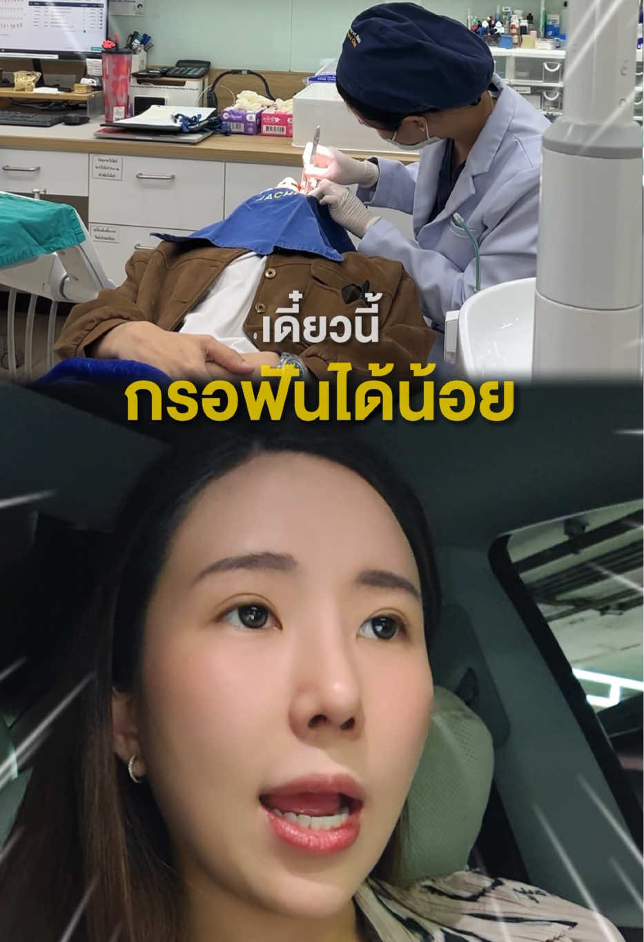 @หมอป่องสวยมาก veneer 🦷