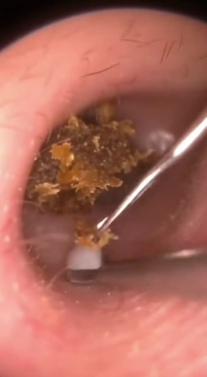 @Ear Cleaning