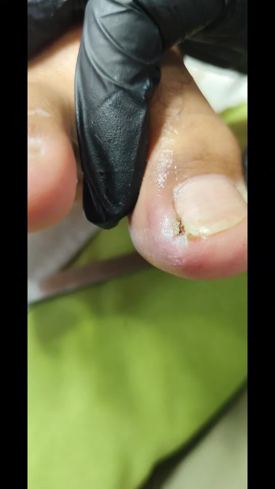 @เล็บขบหาดใหญ่byจิ๊บ