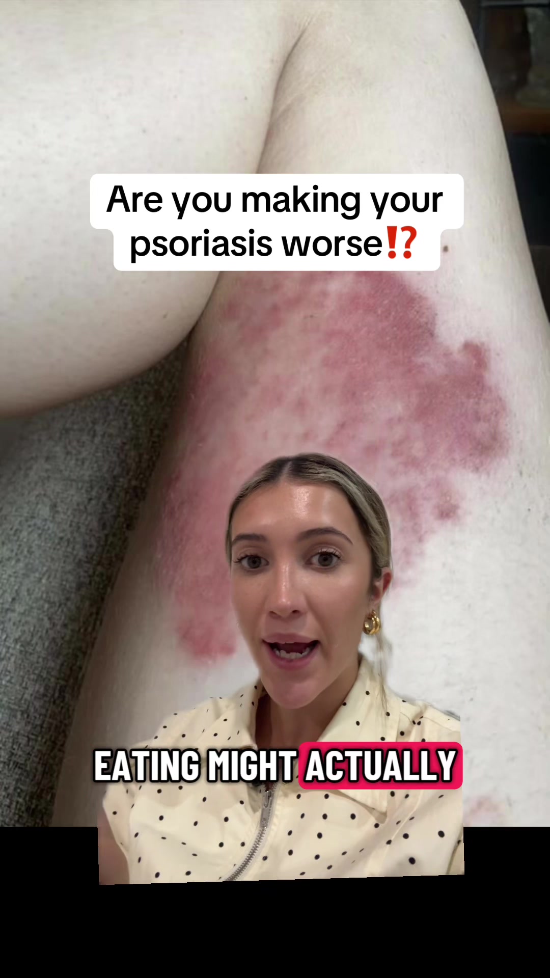 @Eczema Diaries USA & UK