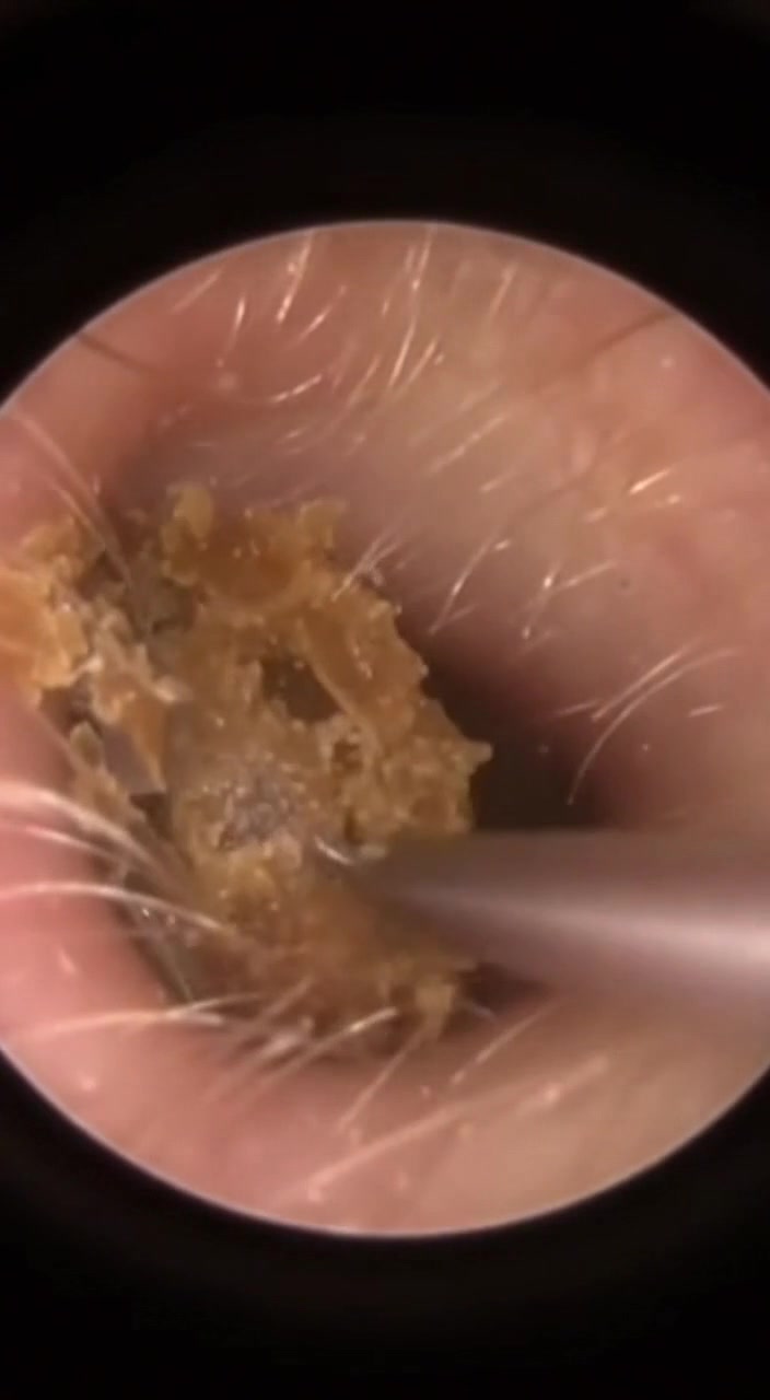 @Ear Cleaning