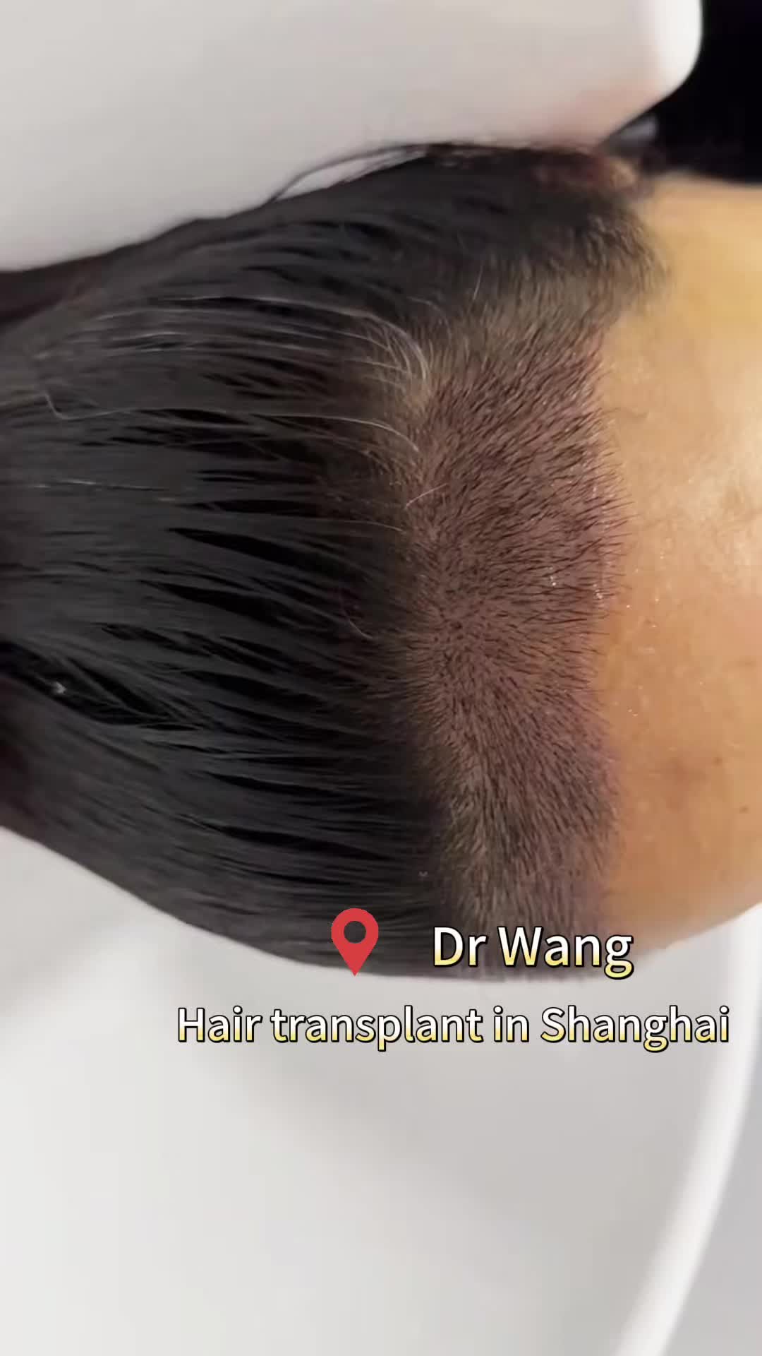 @HAIR TRANSPLANT WANG🇨🇳