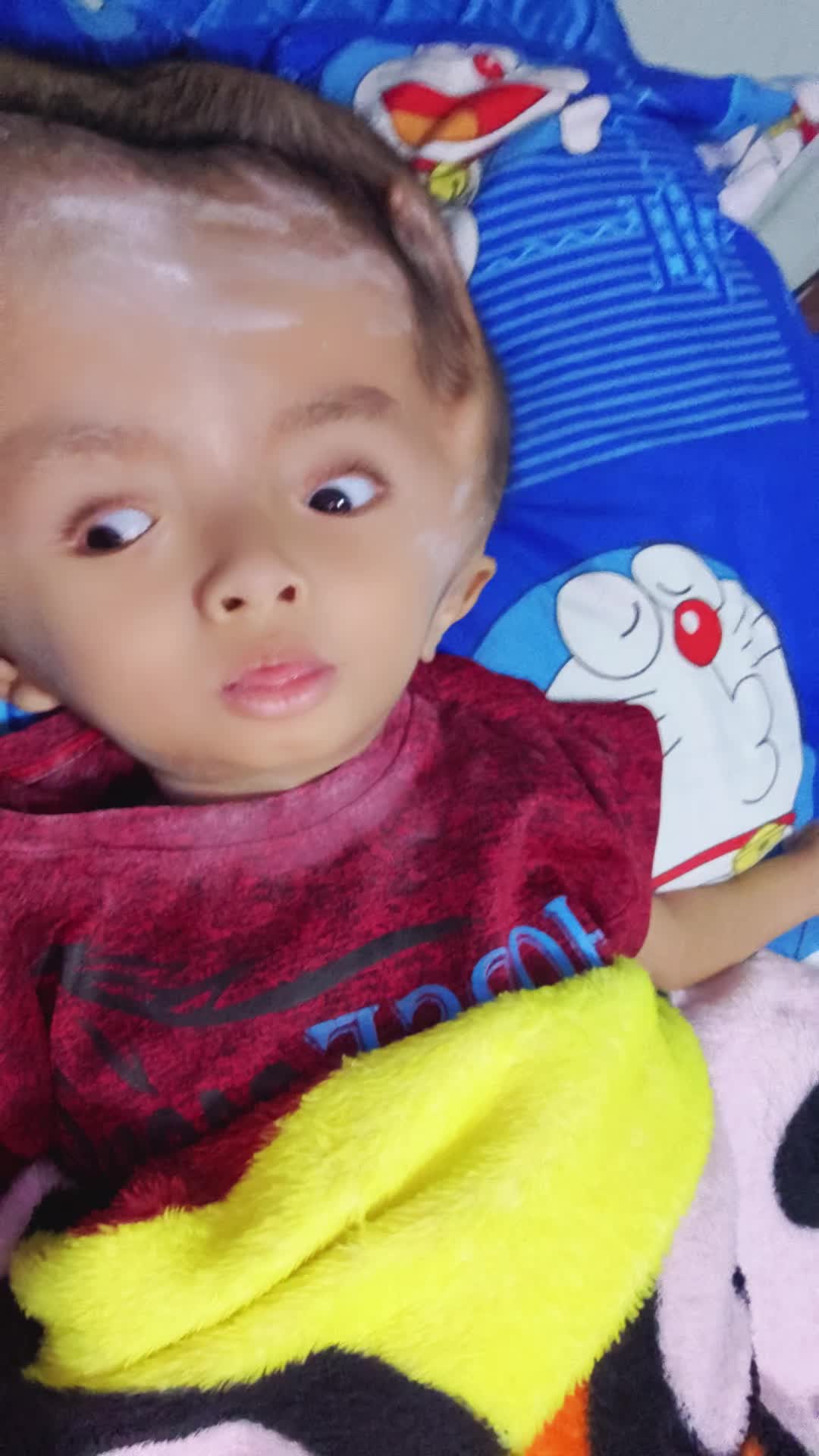 @บู้บี้เด็กหัวโตมีน้ำในโพรงสมอง