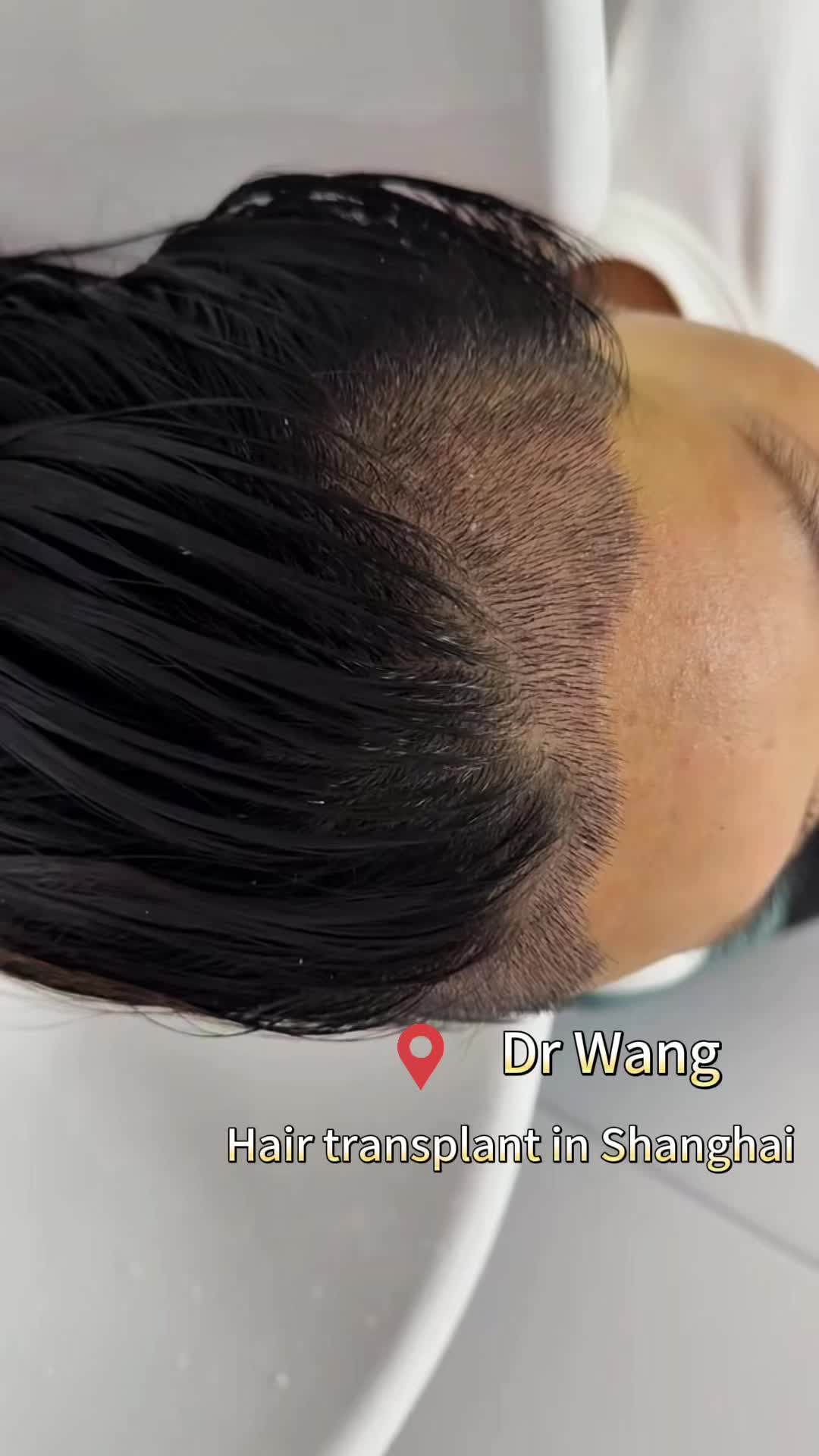 @HAIR TRANSPLANT WANG🇨🇳