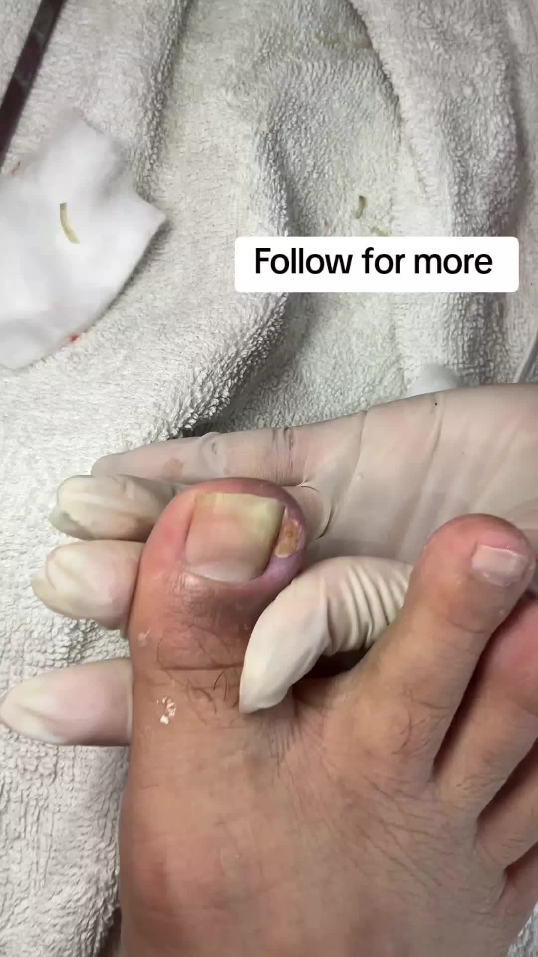 @Pimple Pooping