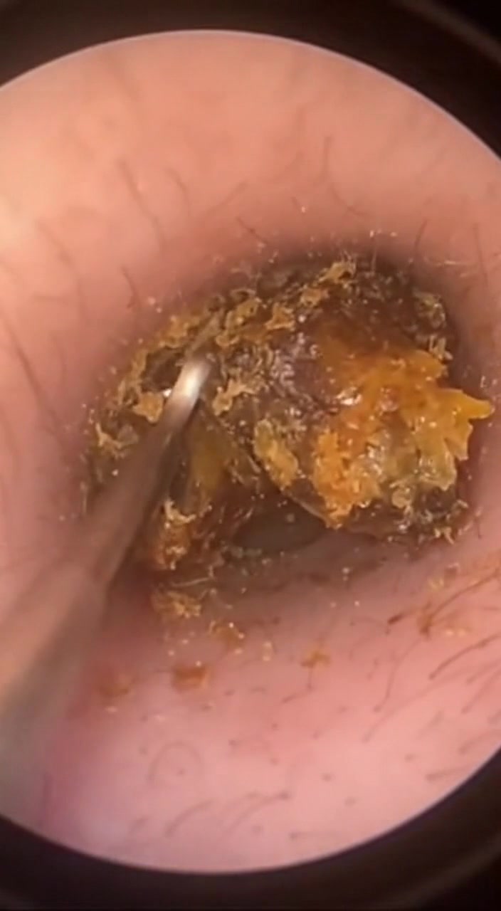 @Ear Cleaning