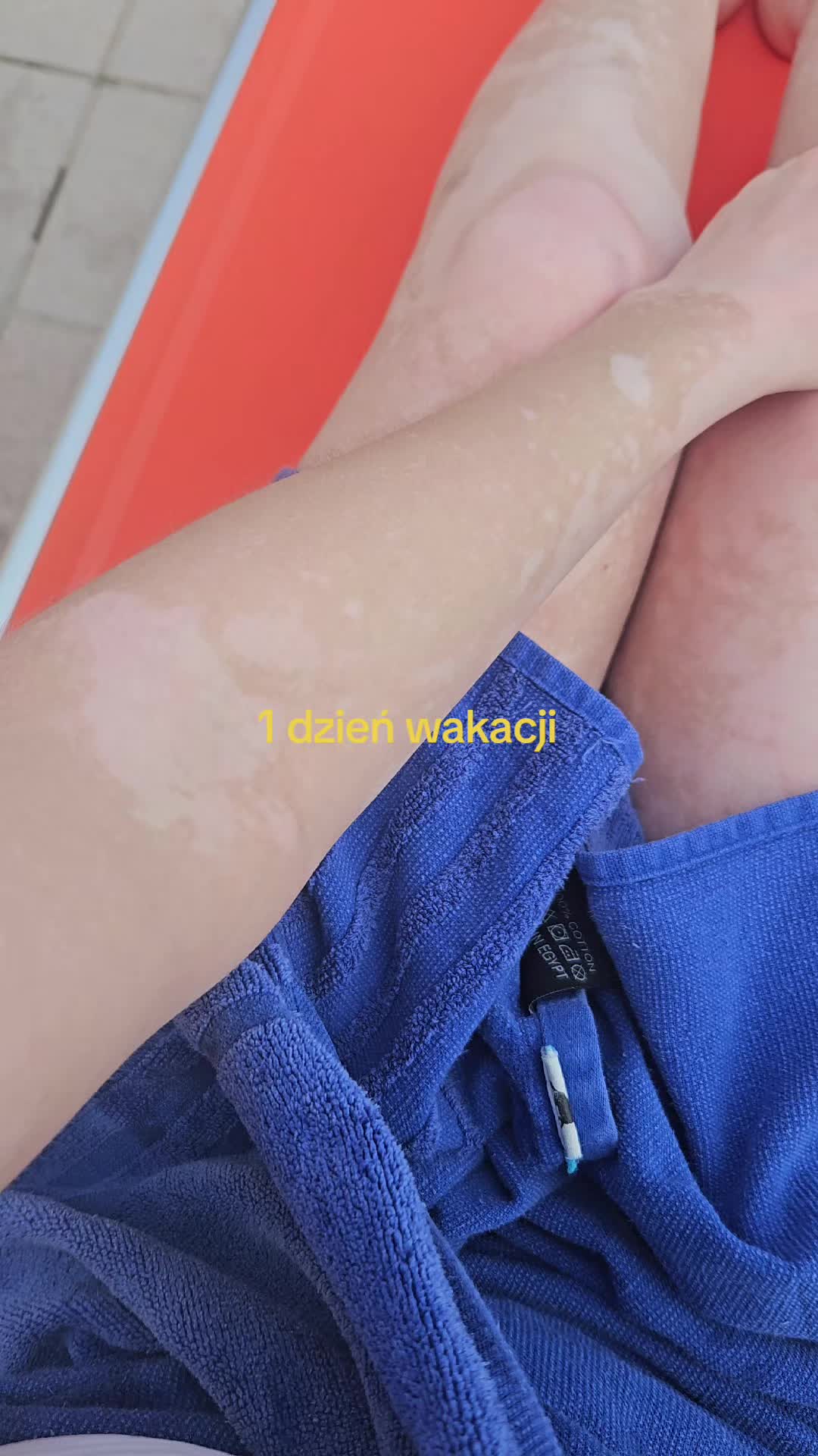@vitiligo.girl