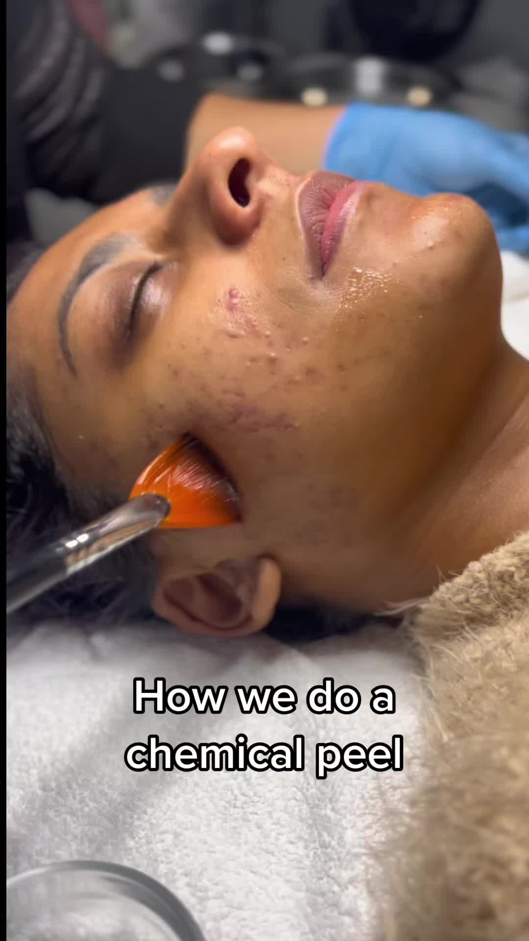 @Adult Acne and Aging Skin