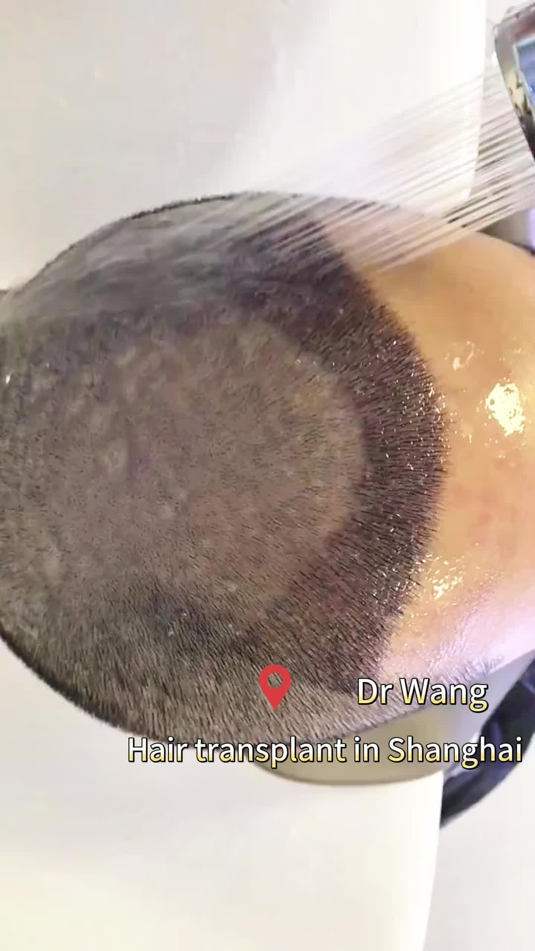 @HAIR TRANSPLANT WANG🇨🇳