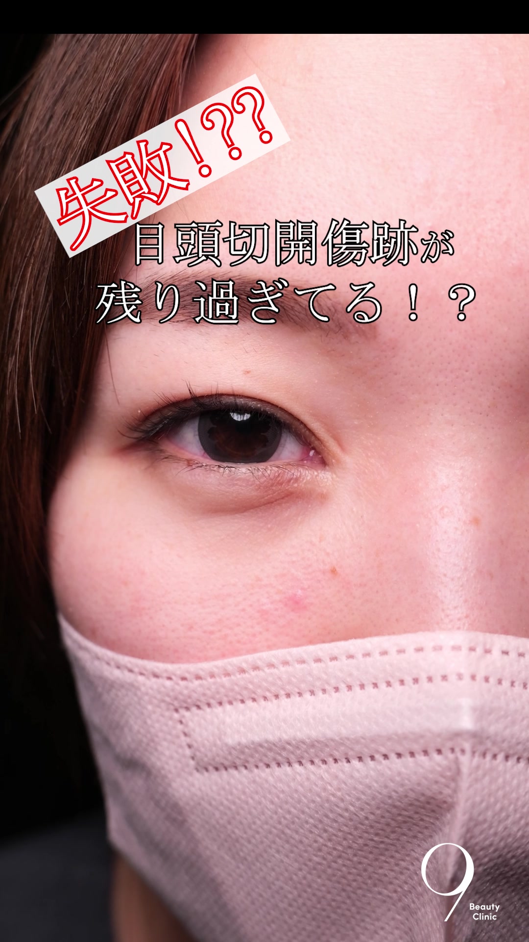 @りく先生　目元切開/クマ治療