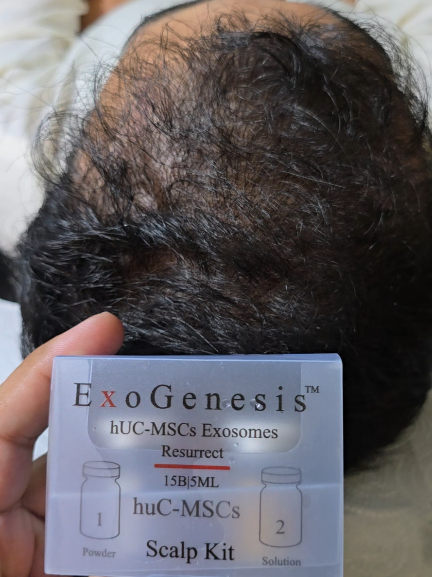 @Dr Asad shalman HairTransplant