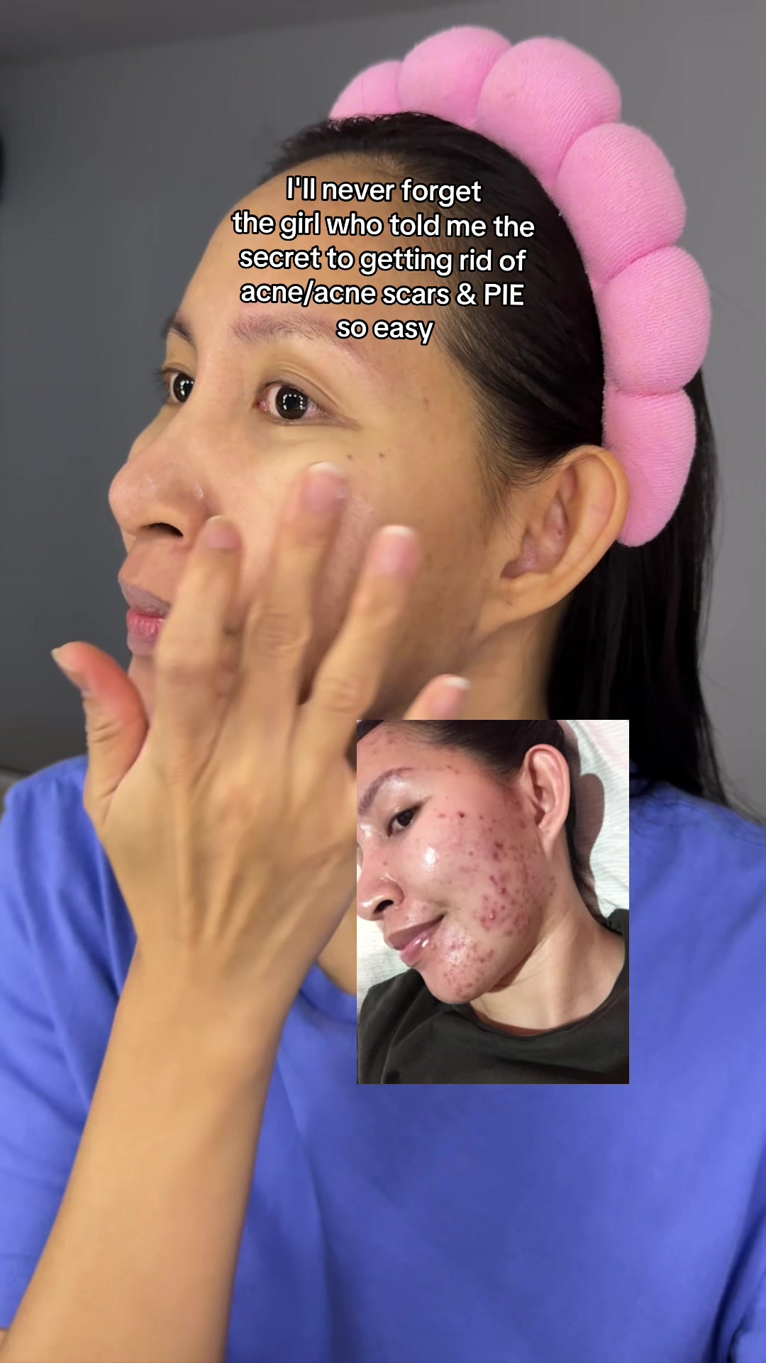 @storyofanacnefighter